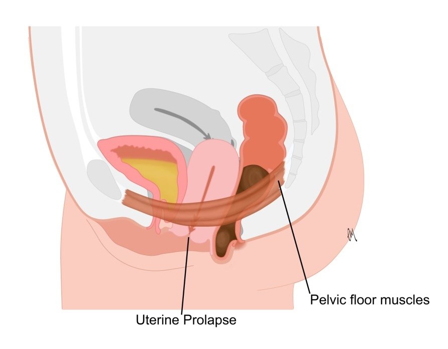 UTERINE PROLAPSE occurs when the pelvic floor muscles and